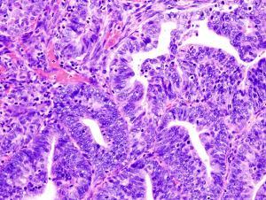 Histopathologic image of endometrial adenocarcinoma in biopsy specimen. 