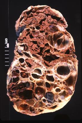 photo of the interior of an adult polycystic kidney