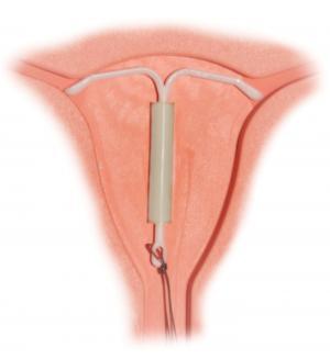 Photo of intrauterine device