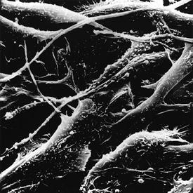 microscopic image of melanoma
