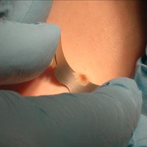 Image of a skin biopsy being performed