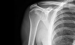 xray image of shoulder